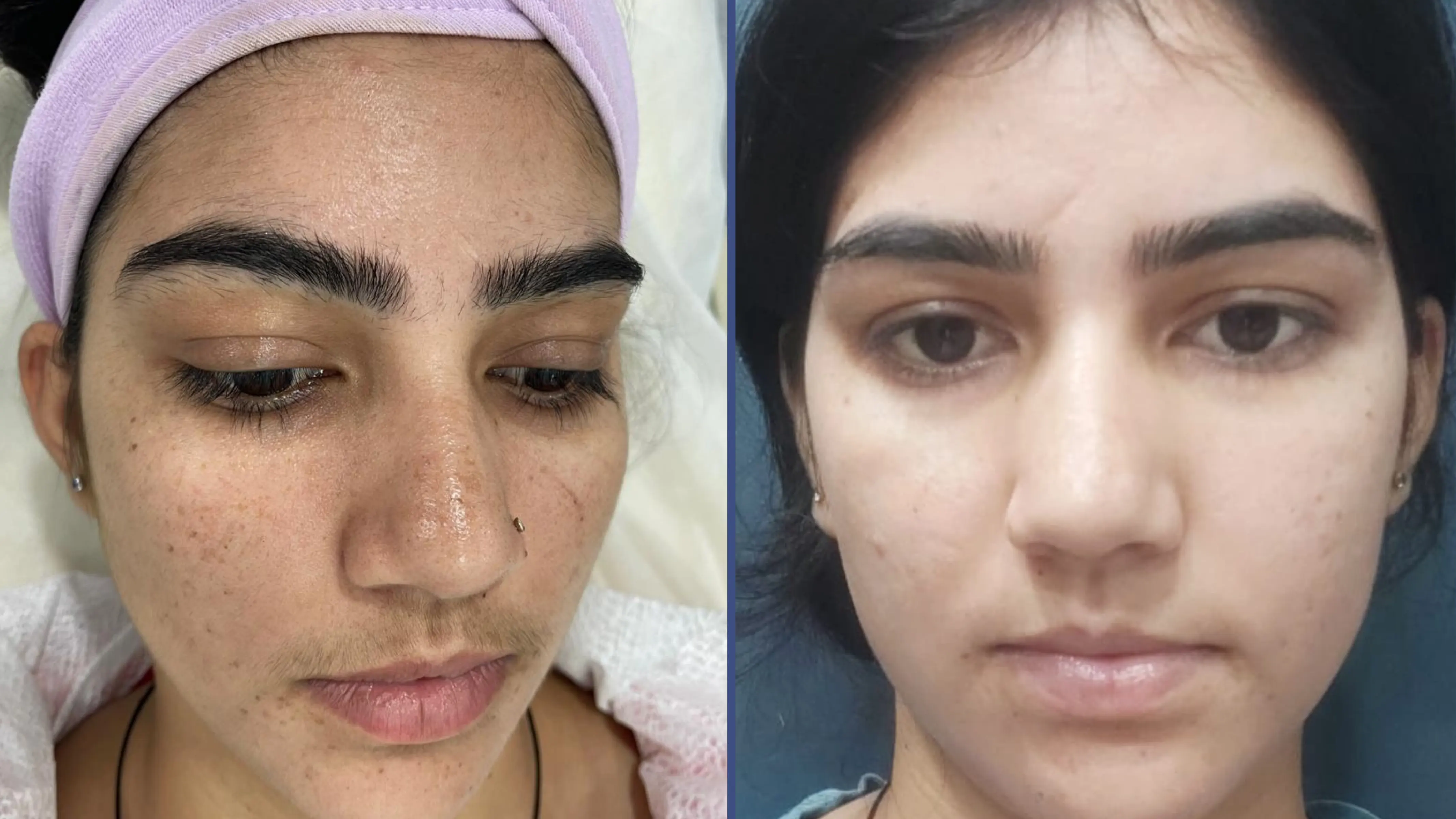 Acne & Blemish Removal